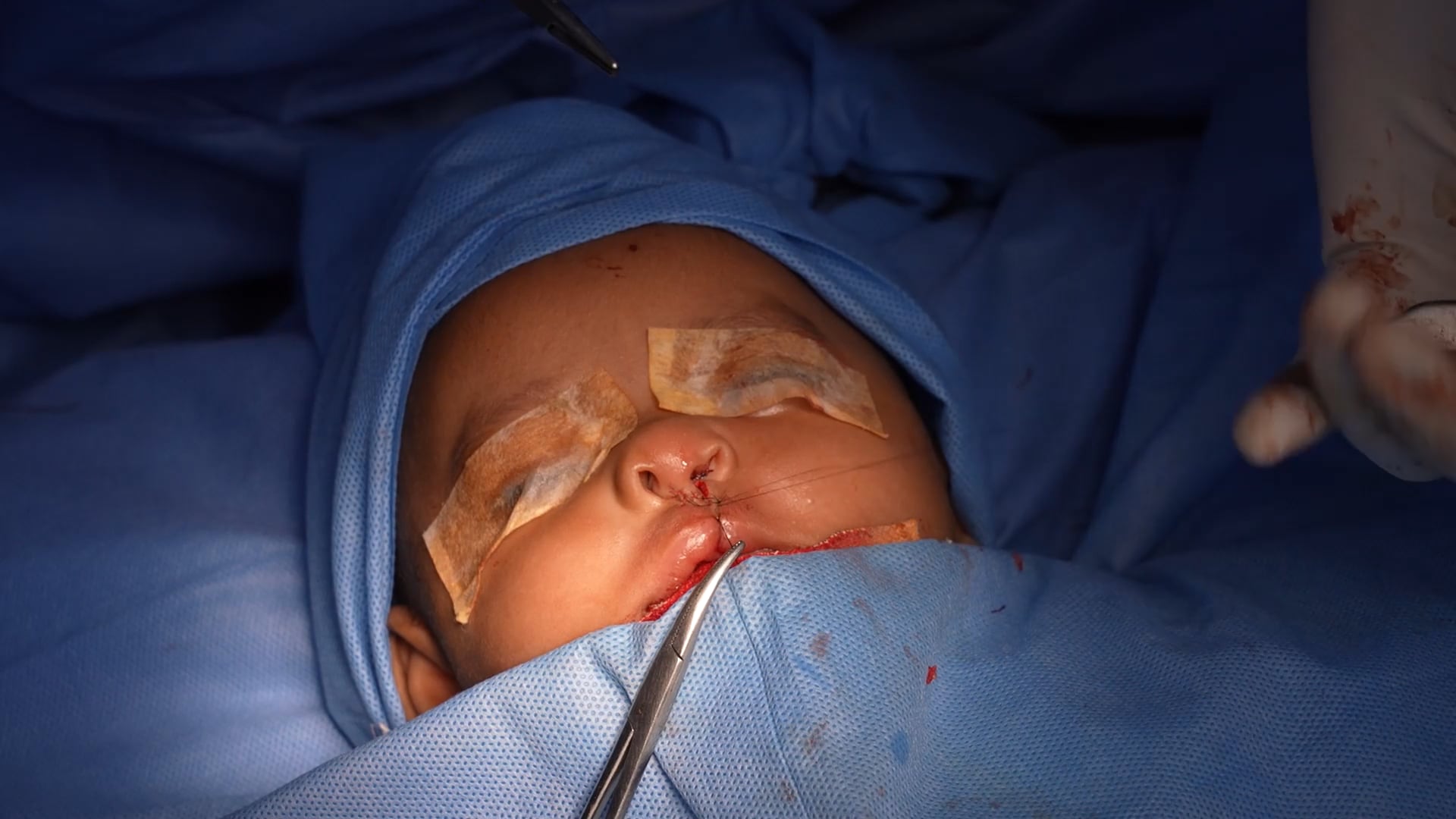 Cleft lip surgery for a baby